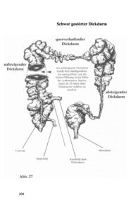 Kopfschmerzen beseitigen; Neurodermitis beseitigen; Colon-hydro-für-zuhause